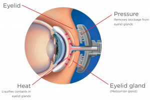 dry eye pressure